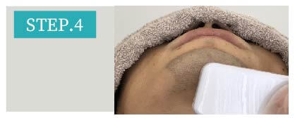 あご裏ひげ脱毛Step4