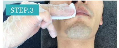鼻下ヒゲ脱毛Step3