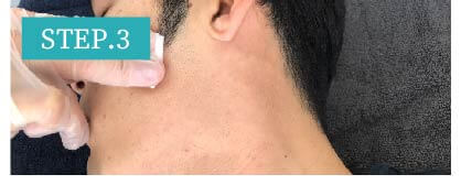 もみあげ脱毛Step3