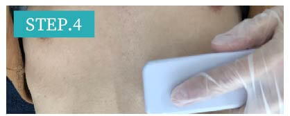 肩脱毛Step4