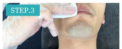 うなじ脱毛Step3