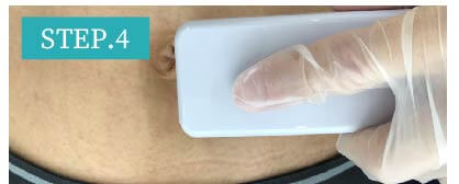 男性器脱毛Step4