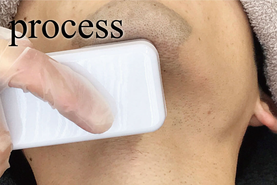 メンズ脱毛の流れ